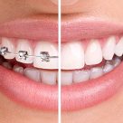 Why Choose Invisalign Instead of Traditional Braces